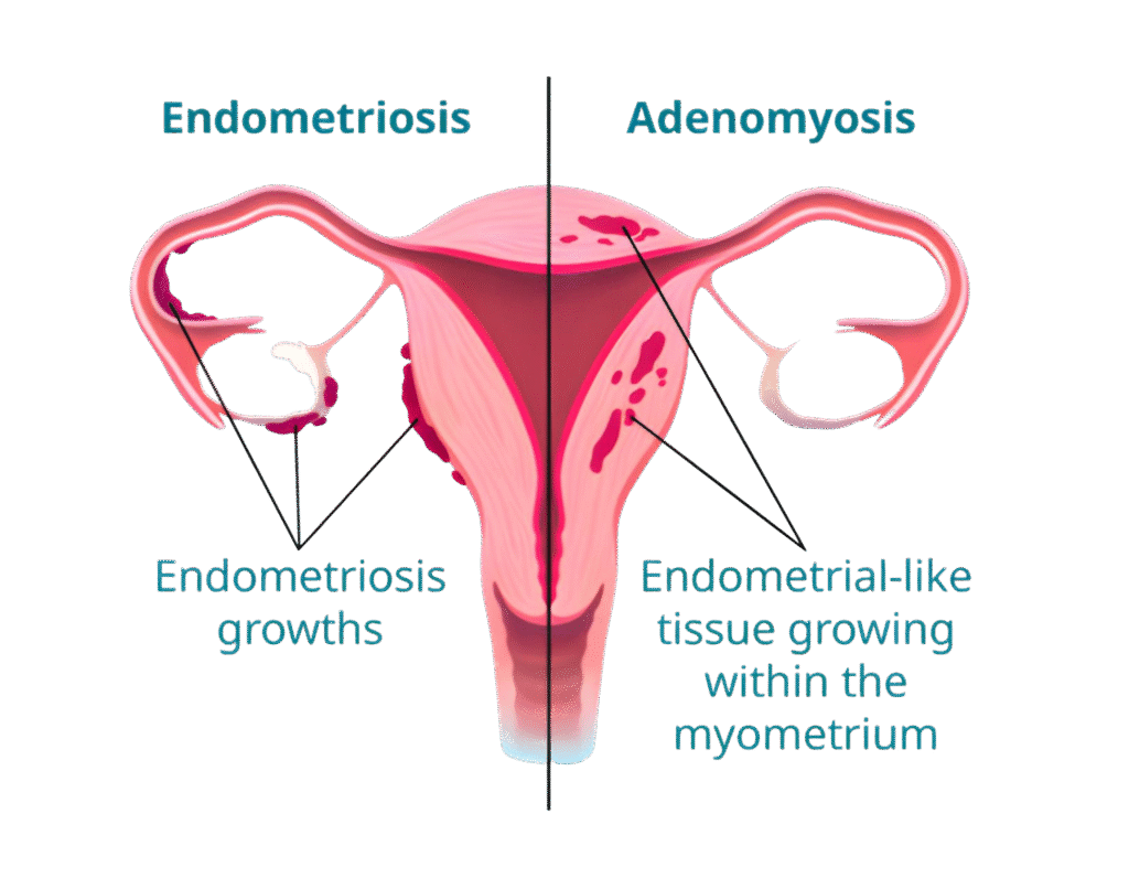 Endometriosis vs Adenomyosis